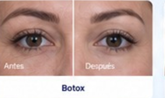 Antes y después de botox